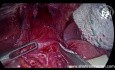 Rehacer la cardiomiotomía de Heller laparoscópica para la acalasia recurrente: ¿es factible la cirugía laparoscópica?