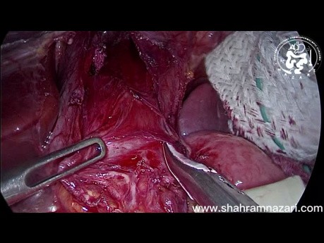 Rehacer la cardiomiotomía de Heller laparoscópica para la acalasia recurrente: ¿es factible la cirugía laparoscópica?