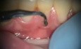 Corrección de restauraciones dentales hechas incorrectamente