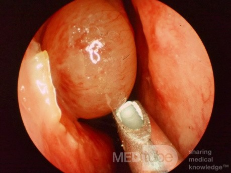 Pólipo nasal con instrumento de succión motorizada