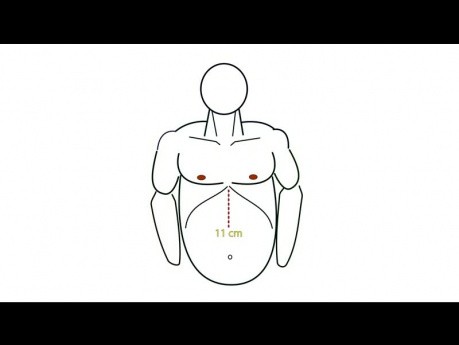 Tutorial de la aplicación de fundoplicatura de geometría; Capítulo 03 Configuración del quirófano y colocación de los trócares