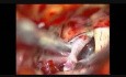 Aneurisma cerebral: aneurisma de bifurcación de la arteria carótida interna