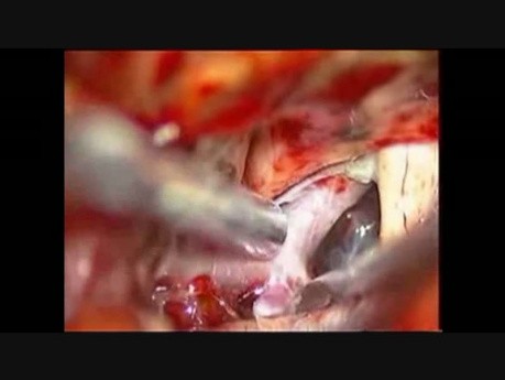 Aneurisma cerebral: aneurisma de bifurcación de la arteria carótida interna