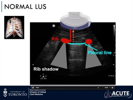 Ultrasonido pulmonar en insuficiencia respiratoria aguda