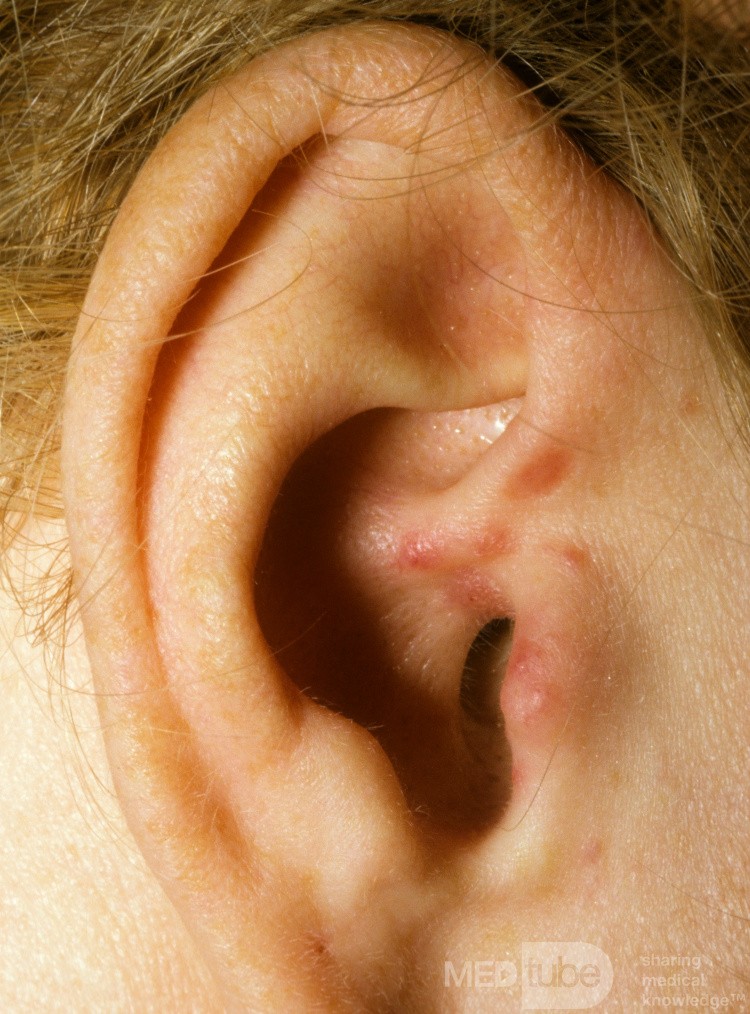 Hiperplasia angiolinfoide con eosinofilia [enfermedad de Kimura]