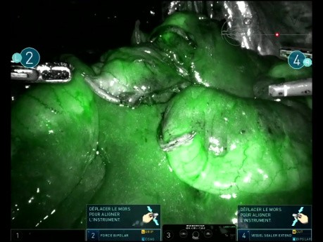 Extracción robótica de intestino delgado guiada por ICG para Bricker del conducto ileal 