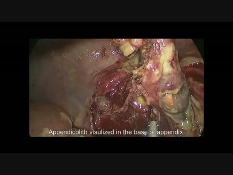 Cirugía laparoscópica urgente por perforación del apéndice