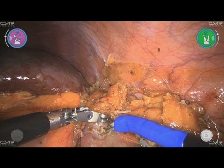 Nefrectomía Parcial Izquierda con Versius - Maurizio De Maria