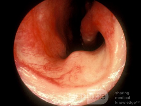 Tejido eréctil en el suelo de la cavidad nasal anterior [lado derecho]