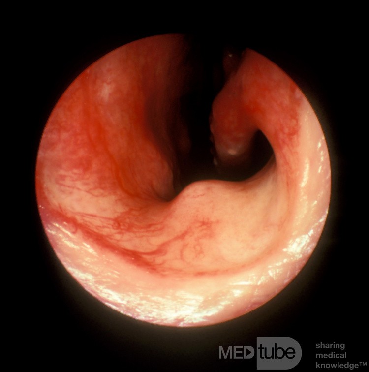 Tejido eréctil en el suelo de la cavidad nasal anterior [lado derecho]