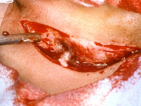 Absceso mastoideo posterior a la incisión auricular