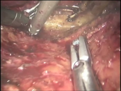 Resección abdominoperineal robótica con sacrectomía distal