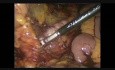 Colectomía total laparoscópica con anastomosis ileo-rectal