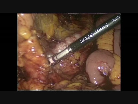 Colectomía total laparoscópica con anastomosis ileo-rectal