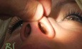 Rinoplastia - Cirugía Plástica de Nariz
