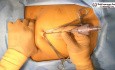 Reparación laparoscópica de una lesión del conducto biliar común (CBC)