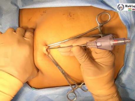 Reparación laparoscópica de una lesión del conducto biliar común (CBC)