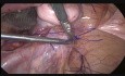 Cervicosacropexia laparoscópica con lío de prolina