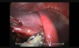 Extirpación laparoscópica de un quiste del bazo