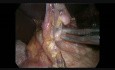 Esofagectomía de İvor-Lewis mínimamente invasiva