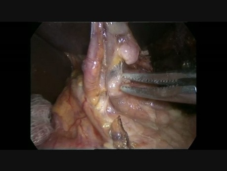 Esofagectomía de İvor-Lewis mínimamente invasiva