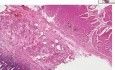 Esófago de Barrett - examen histopatológico - esófago