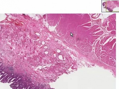 Esófago de Barrett - examen histopatológico - esófago