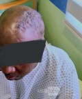 Craniectomía descompresiva en infarto maligno de la arteria cerebral media