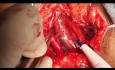 Cómo realizar una FAV de extensión inferior con Goretex en un paciente con Superior Vena Cava Syndroma (SVCS) previo y endocarditis de la válvula tricúspide (VT)