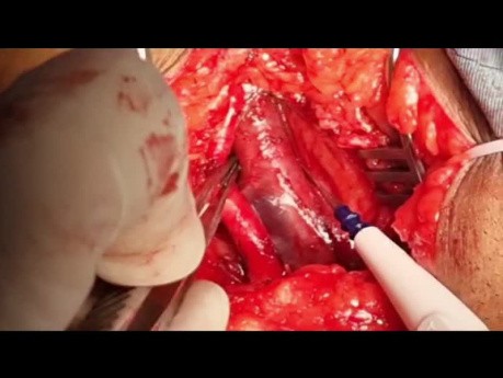 Cómo realizar una FAV de extensión inferior con Goretex en un paciente con Superior Vena Cava Syndroma (SVCS) previo y endocarditis de la válvula tricúspide (VT)