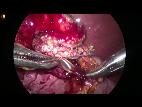 Atrapamiento del stent en suturas