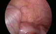 Reducción laparoscópica de la invaginación intestinal en lactante