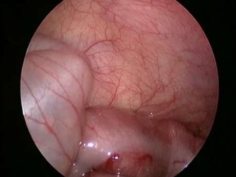 Reducción laparoscópica de la invaginación intestinal en lactante