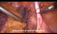 Apendicectomía laparoscópica