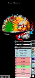 Planificación quirúrgica con neuronavegador en paciente con lesión de masa intracraneal. Glioma de alto grado.