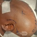 Craniectomía descompresiva en infarto maligno de la arteria cerebral media