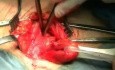 Reparación de hernia inguinal