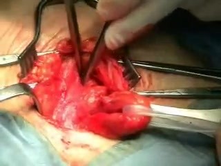 Reparación de hernia inguinal