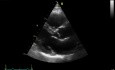 Ecocardiografía tridimensional en tiempo real: vista paraesternal en eje largo de la válvula mitral, vídeo n.º 3