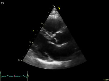 Ecocardiografía tridimensional en tiempo real: vista paraesternal en eje largo de la válvula mitral, vídeo n.º 3