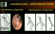 Apendicectomía Laparoscópica - Cirugía 