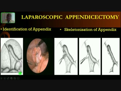 Apendicectomía Laparoscópica - Cirugía 