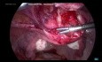 Uterolisis laparoscópica - Parte 1
