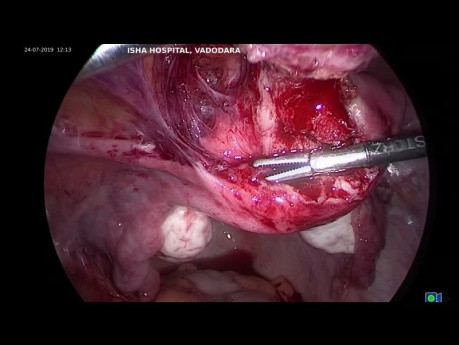 Uterolisis laparoscópica - Parte 1