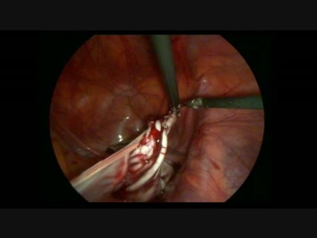 Cistectomía ovárica masiva laparoscópica
