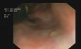 Tumor en la unión rectosigmoidea, varices rectales, un pólipo rectal pequeño