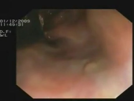 Tumor en la unión rectosigmoidea, varices rectales, un pólipo rectal pequeño