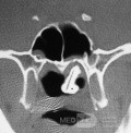 Tomografía computarizada de rinolitos