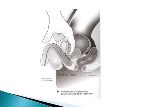 Adenomectomía Prostática Transvesical y Retropúbica
