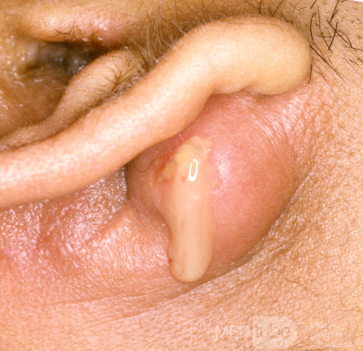 Absceso mastoideo